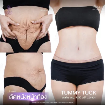 10.Web_รีไซซ์ตัดหนังหน้าท้อง