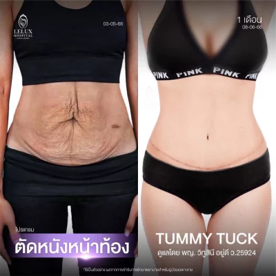 13.Web_รีไซซ์ตัดหนังหน้าท้อง