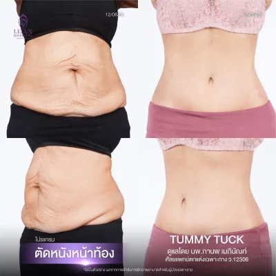 19.Web_รีไซซ์ตัดหนังหน้าท้อง