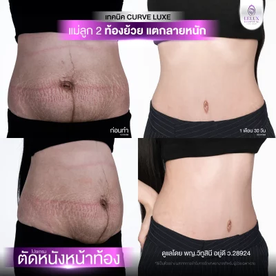 2.Web_รีไซซ์ตัดหนังหน้าท้อง